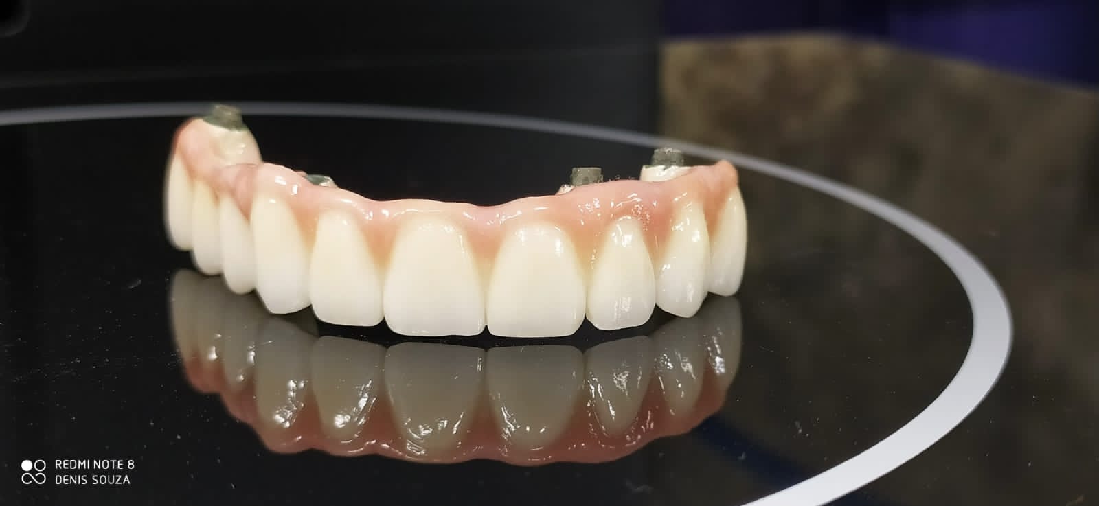 Prótese sobre implantes premium
